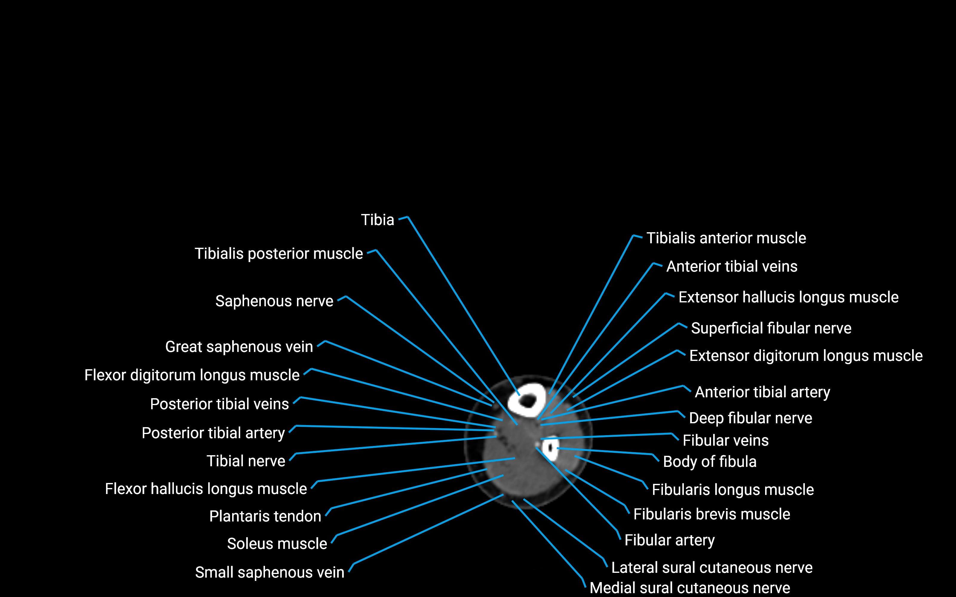 CT Lower leg axial cross sectional anatomy labelled image 143 (2).png